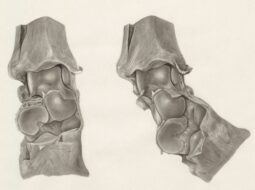 Orthopedic Implants